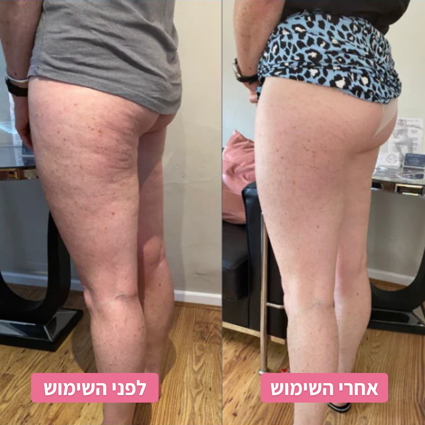 המארז הביתי להפחתת הצלוליט